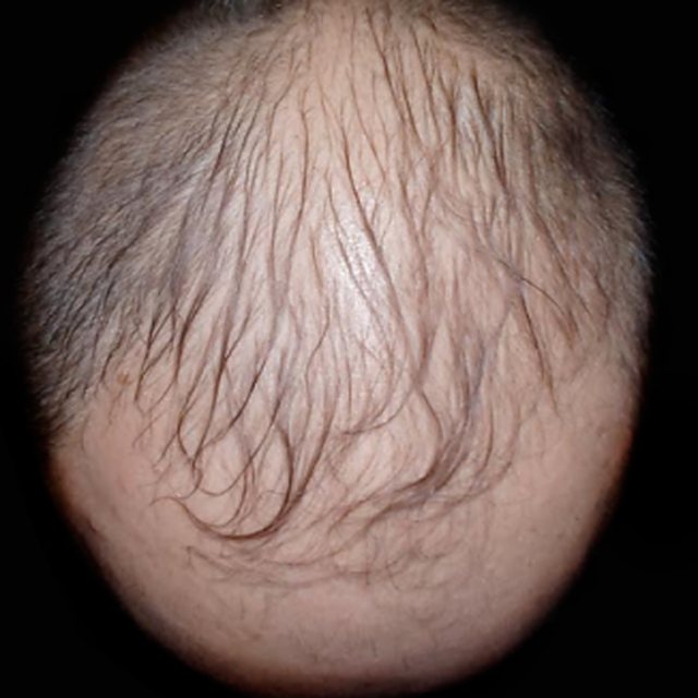 Cuoio capelluto visto dall'alto prima della cura, caso 1